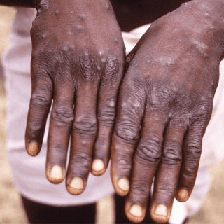 Conoce los síntomas del mpox