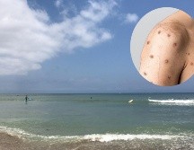 La Secretaría de Salud estatal reconoce que el presunto caso de mpox aún no está confirmado. EL INFORMADOR/ ARCHIVO