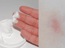 Barmicil es una crema que se utiliza para combatir irritaciones, sequedad, enrojecimiento y picazón de la piel. ESPECIAL/Imagen de Mizianitka en Pixabay/ Imagen de Angela Roma en Pexels