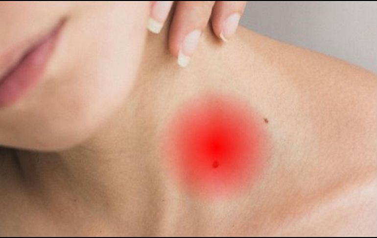 Las picaduras suelen desaparecer al cabo de una a dos semanas. UNSPLASH / A. ECHEVERRY