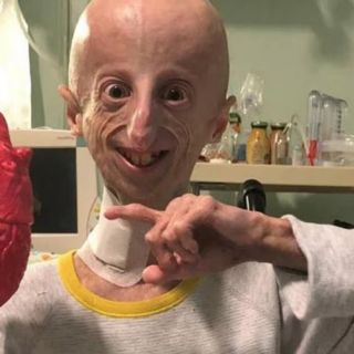 Síntomas del síndrome de progeria o envejecimiento prematuro en niños y niñas