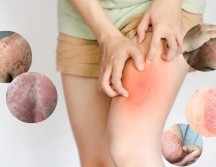La psoriasis es una enfermedad autoinmune que provoca la aceleración del ciclo de vida de las células de la piel, lo que resulta en la formación de escamas y parches rojos que pueden ser dolorosos y picar. CANVA