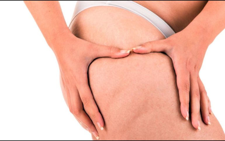 La celulitis es una condición común que puede verse afectada por varios hábitos de vida. El sedentarismo es uno de los principales factores que pueden empeorar su apariencia, pero adoptar hábitos saludables como el ejercicio regular, una dieta equilibrada y el cuidado adecuado de la piel puede marcar una gran diferencia.  CANVA