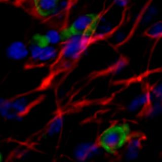 Estudio revela que la progresión del párkinson puede reducirse con esta terapia