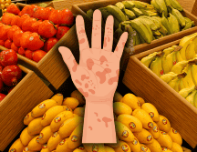La psoriasis es una condición que genera inflamación y descamación en la piel, lo que puede causar picazón, enrojecimiento y molestias significativas. EL INFORMADOR / ARCHIVO