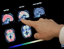 El proyecto, dirigido a ancianos sanos, con deterioro cognitivo precoz y con fragilidad, busca mejorar las herramientas de diagnóstico y evaluación del Alzheimer. AP / ARCHIVO