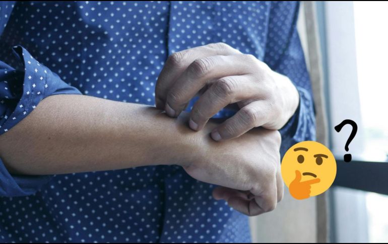 Aliviar la comezón razcando la zona empeora los síntomas y ralentiza la curación. ESPECIAL / Pexels y Canva