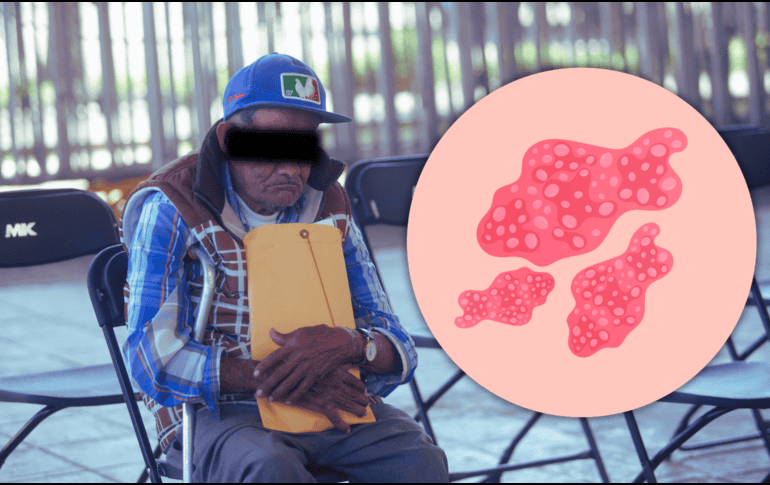 El herpes zóster es más común entre los adultos mayores y las personas con sistemas inmunológicos comprometidos. EL INFORMADOR / ARCHIVO