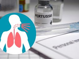 De acuerdo con la SSa, la tos ferina es una infección respiratoria aguda altamente contagiosa causada por la bacteria Bordetella pertussis. ESPECIAL / CANVA