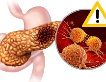 Dado que los primeros síntomas del cáncer de páncreas pueden confundirse con otras enfermedades menos graves, es fundamental acudir a un especialista ante la presencia de estas señales. CANVA