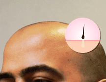 La alopecia androgenética afecta al 50% de los hombres mayores de 50 años y se vuelve cada vez más común con la edad. EL INFORMADOR / ARCHIVO
