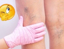 Estos remedios caseros pueden ser de gran ayuda para aliviar los síntomas leves de las várices, pero no sustituyen el diagnóstico ni el tratamiento médico. CANVA