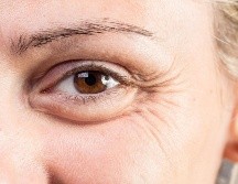 Aunque no representan un riesgo para la salud, muchas personas buscan eliminar las bolsas en los ojos por cuestiones estéticas. ESPECIAL / CANVA