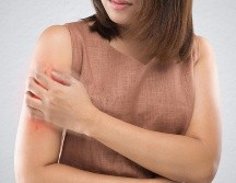 Esta erupción por calor, a primera vista se ve como pequeñas ampollas o bultos inflamados, y pueden provocar ardor y comezón. ESPECIAL / CANVA