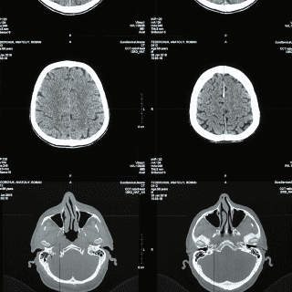 Conoce el ejercicio ideal para PREVENIR la demencia