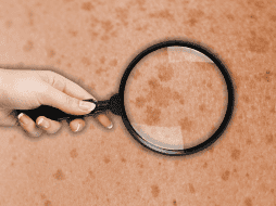 Hay algunas pecas que pueden aparecer y desaparecer conforme nos asoleamos. ESPECIAL / CANVA