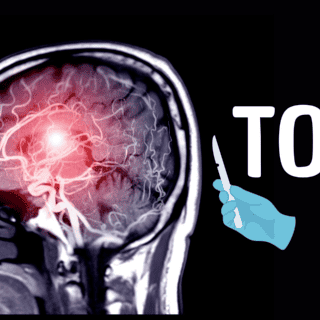 Encuentran posible nueva "esperanza" para pacientes con TOC severo en la neurocirugía