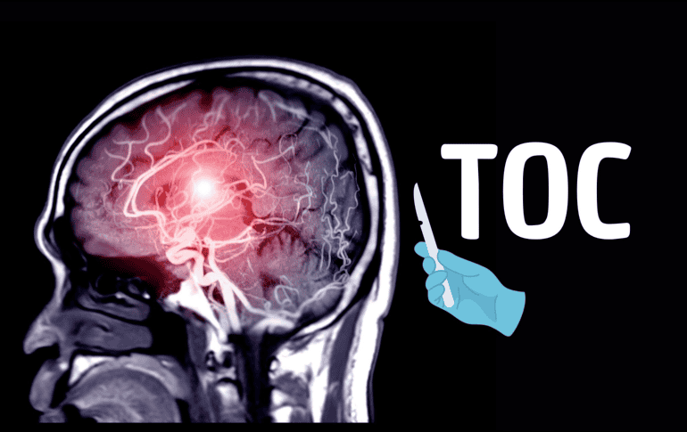 Frente al sufrimiento de quienes no encuentran alivio con terapias convencionales, la neurocirugía psiquiátrica continúa abriéndose paso como una opción prometedora, aunque todavía rodeada de cautela.  CANVA