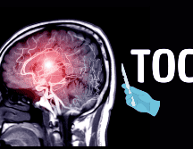 Frente al sufrimiento de quienes no encuentran alivio con terapias convencionales, la neurocirugía psiquiátrica continúa abriéndose paso como una opción prometedora, aunque todavía rodeada de cautela.  CANVA