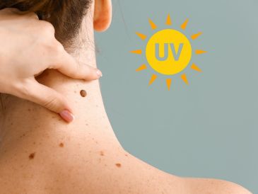 El melanoma, un tumor cutáneo grave, se asemeja a un lunar, pero a menudo con las siguientes características: asimetría, bordes irregulares, varios colores, agrandamiento o cambio de aspecto. ESPECIAL / CANVA