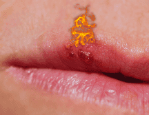 El herpes labial puede durar, generalmente, de una a dos semanas. ESPECIAL / CANVA