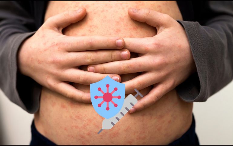El sarampión es una enfermedad prevenible mediante la aplicación de una vacuna. ESPECIAL / CANVA