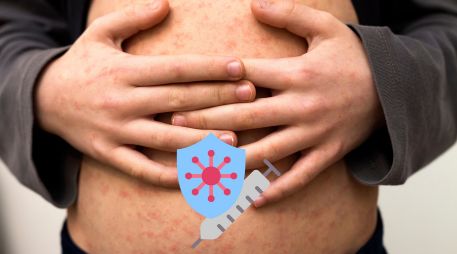 El sarampión es una enfermedad prevenible mediante la aplicación de una vacuna. ESPECIAL / CANVA