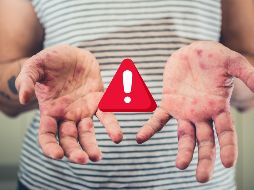 El secretario de Salud en Jalisco, Héctor Raúl Pérez Gómez, informó que 39 de los casos se registraron en el municipio de Arandas. ESPECIAL