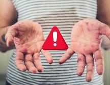 El Comité Nacional para la Vigilancia Epidemiológica emitió un aviso epidemiológico, para promover que el personal de salud a detecte y notifique los casos probables de sarampión o rubéola. ESPECIAL / CANVA