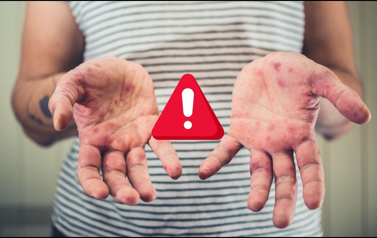 El secretario de Salud en Jalisco, Héctor Raúl Pérez Gómez, informó que 39 de los casos se registraron en el municipio de Arandas. ESPECIAL