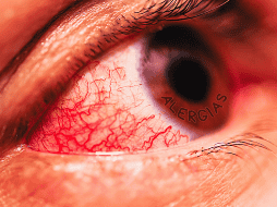 La conjuntivitis es la inflamación de la membrana que recubre la parte blanca de los ojos (conjuntiva) y puede ser causada por alergias. ESPECIAL / CANVA