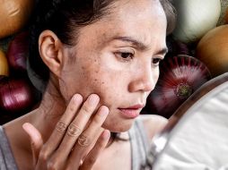 La cebolla, más allá de ser un básico culinario, es un ingrediente con propiedades dermatológicas prometedoras. CANVA