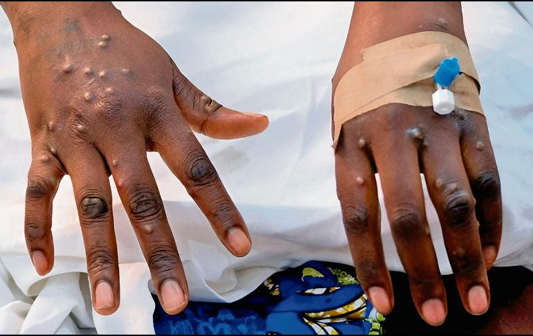 Autoridades sanitarias trabajan en contener el brote. ESPECIAL