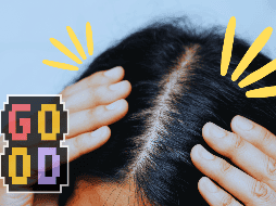 Los primeros resultados de este tratamiento para la calvicie fueron muy positivos. ESPECIAL / Canva