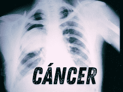 Los pacientes exfumadores tenían un 60% más de riesgo de desarrollar una segunda neoplasia y los que seguían fumando también mostraron un incremento de riesgo 