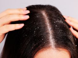 Aunque no existe una cura definitiva, el tratamiento adecuado puede mantener los síntomas bajo control y mejorar la salud del cuero cabelludo. ESPECIAL / CANVA