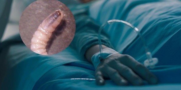 Detectan primer caso de gusano barrenador en una persona en M&eacute;rida