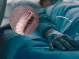 Desde el primer caso de un humano contagiado de GBG en México, registrado el pasado 19 de abril, solo se habían presentado en Chiapas y Campeche. CANVA / ESPECIAL