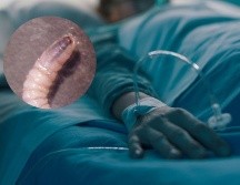 Al menos 5 de los casos perdieron la vida mientras recibían tratamiento, aunque ninguno está atribuido al caso de miasis. CANVA / ESPECIAL