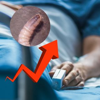 Preocupa incremento de miasis en humanos por gusano barrenador