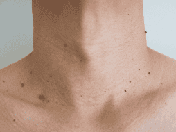 Las verrugas en el cuello son frecuentes y, aunque en la mayoría de los casos no representan un peligro, pueden generar molestias físicas y emocionales. CANVA