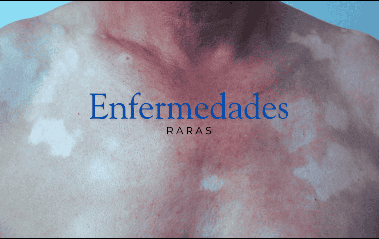 Esta enfermedad presenta alteraciones de coloración como hiperpigmentación o manchas similares al vitíligo. ESPECIAL / CANVA