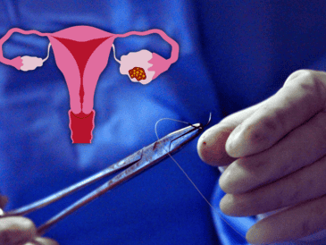 El IMSS en Querétaro tiene un registro de 13 casos de cáncer de ovario durante 2024, la mayoría a mujeres entre 25 y 65 años de edad; en lo que va del año se tiene un registro de tres casos. ESPECIAL / CANVA