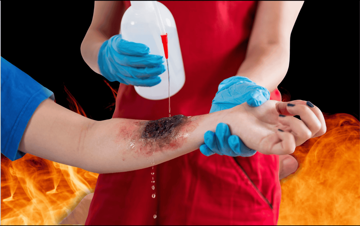 Las quemaduras de segundo y tercer grado no son solo lesiones superficiales: su profundidad y extensión pueden desencadenar una serie de complicaciones críticas que amenazan la vida.  CANVA