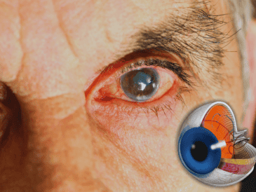 el glaucoma puede incapacitar a las personas, especialmente a los adultos mayores, quienes progresivamente pierden la visión hasta llegar a la ceguera. ESPECIAL / CANVA