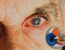 El glaucoma puede incapacitar a las personas, especialmente a los adultos mayores, quienes progresivamente pierden la visión hasta llegar a la ceguera. ESPECIAL / CANVA