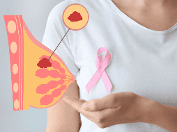 Es posible que el cáncer de mama no cause síntomas en un inicio o que el bulto sea tan pequeño que no pueda ser palpable. ESPECIAL / CANVA