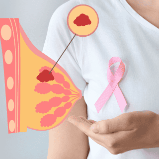 ¿Cuáles son los signos y síntomas del cáncer de mama?