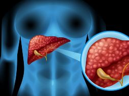 El hígado graso no alcohólico se asocia estrechamente con el síndrome metabólico, la obesidad, la diabetes tipo 2 y los niveles altos de colesterol o triglicéridos.  CANVA