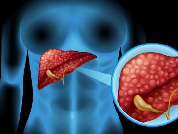 El hígado graso no alcohólico se asocia estrechamente con el síndrome metabólico, la obesidad, la diabetes tipo 2 y los niveles altos de colesterol o triglicéridos.  CANVA